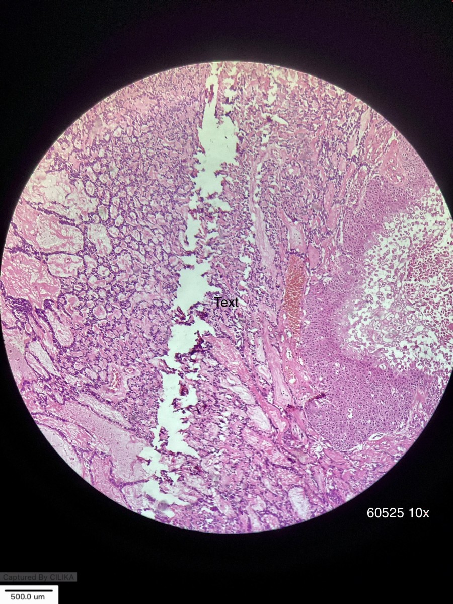 When Parotid visit Cervix